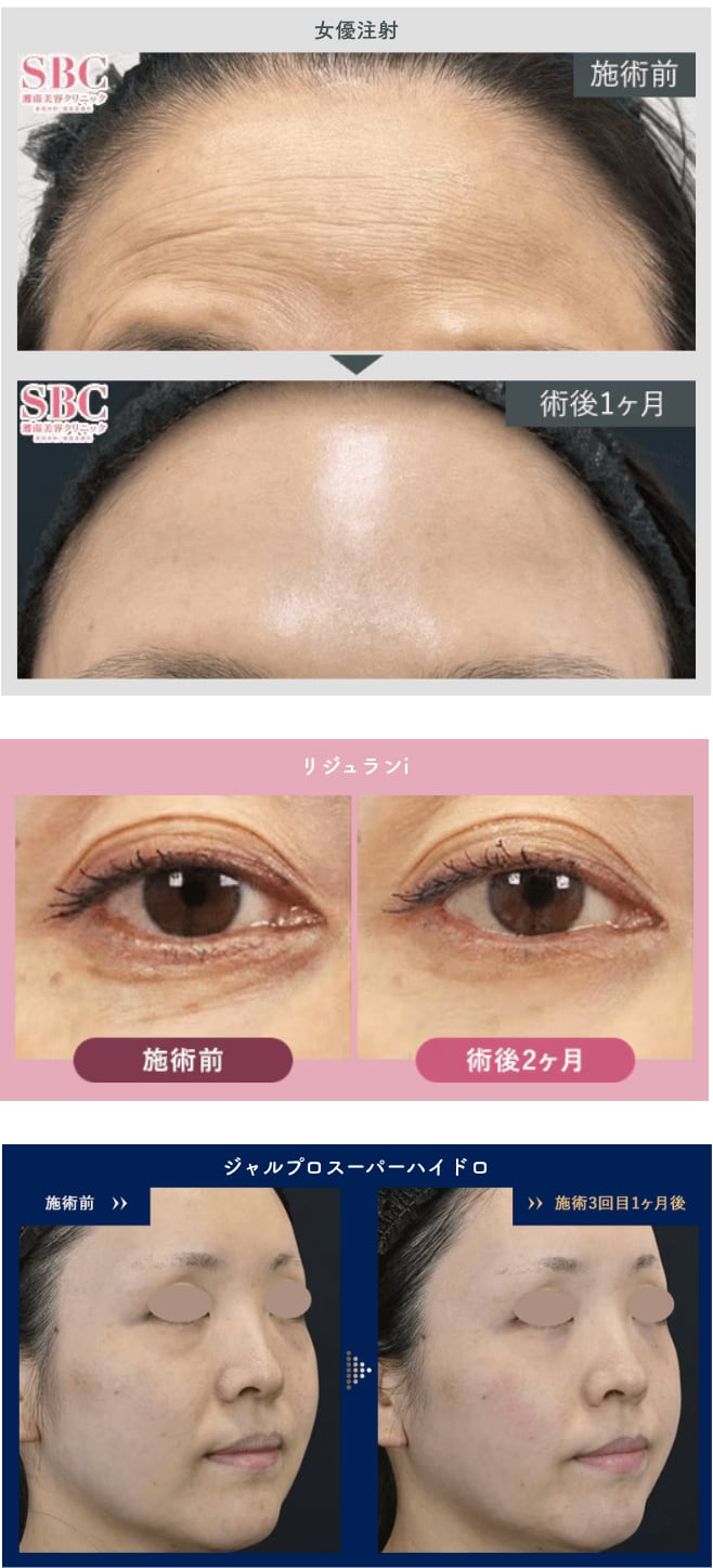 肌育注射でこんなに変わる💫
